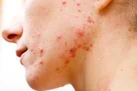 Treating adult and teenage acne naturally